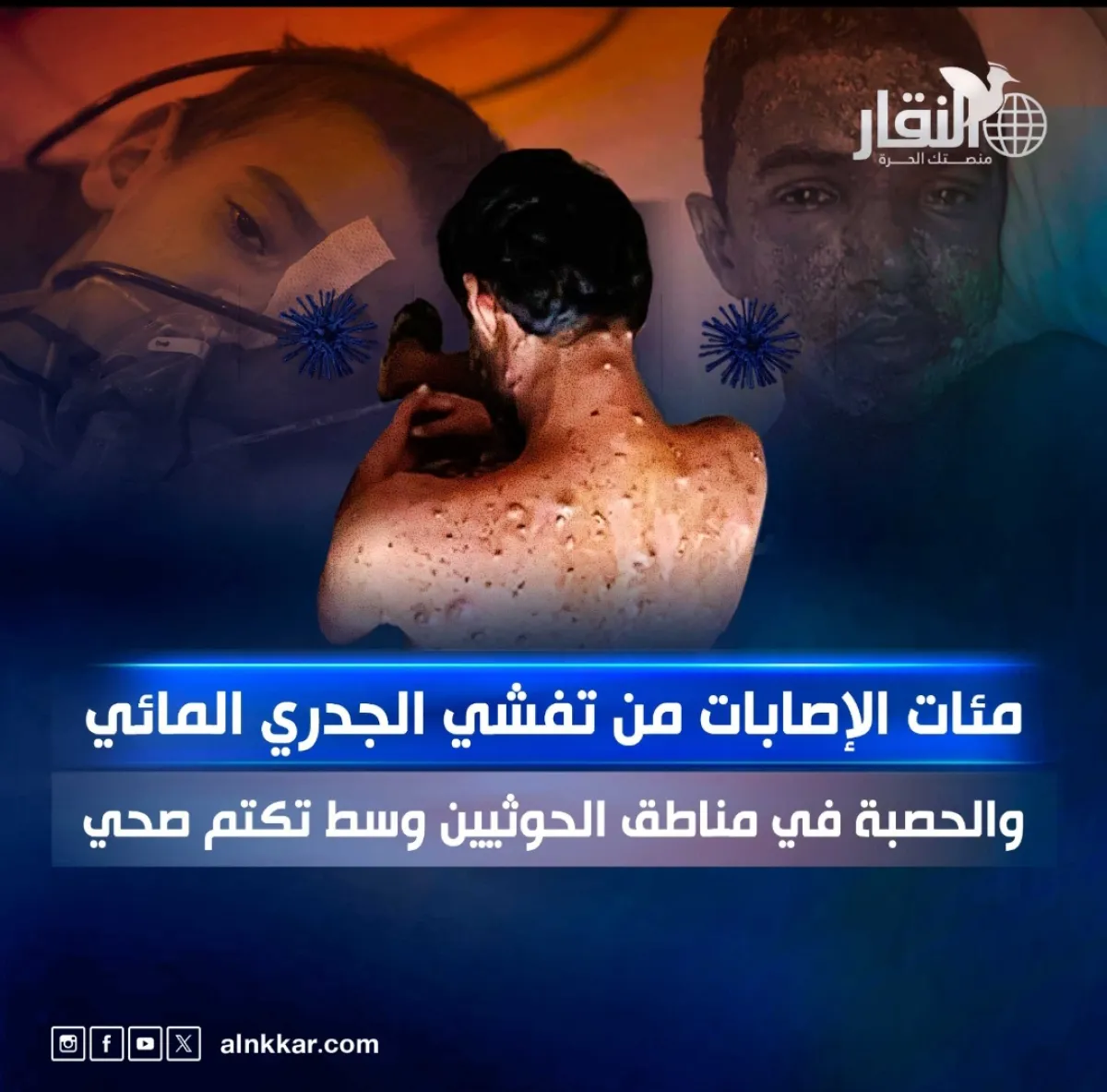 مئات الإصابات من تفشّي الجدري المائي والحصبة في مناطق الحوثيين وسط تكتم صحي