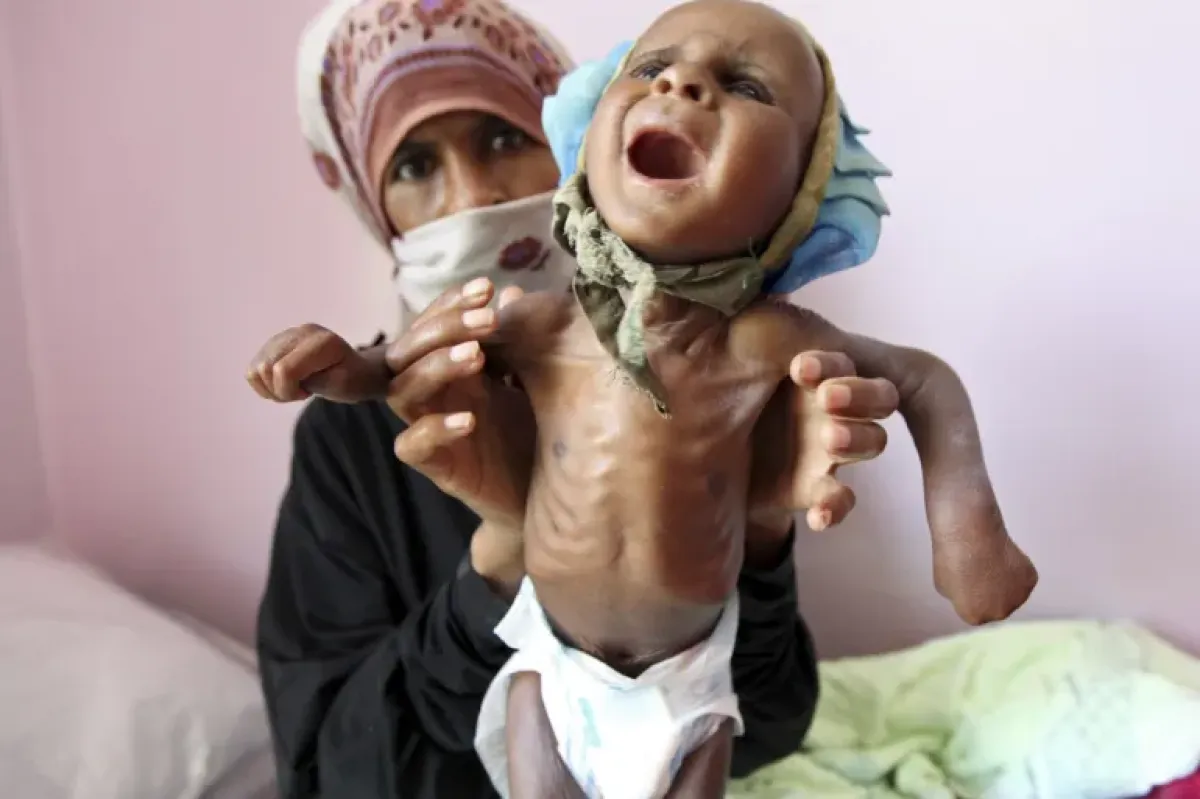 تقرير أممي: ثلث الأطفال دون سنتين في اليمن يعانون فقرا غذائيا شديدا