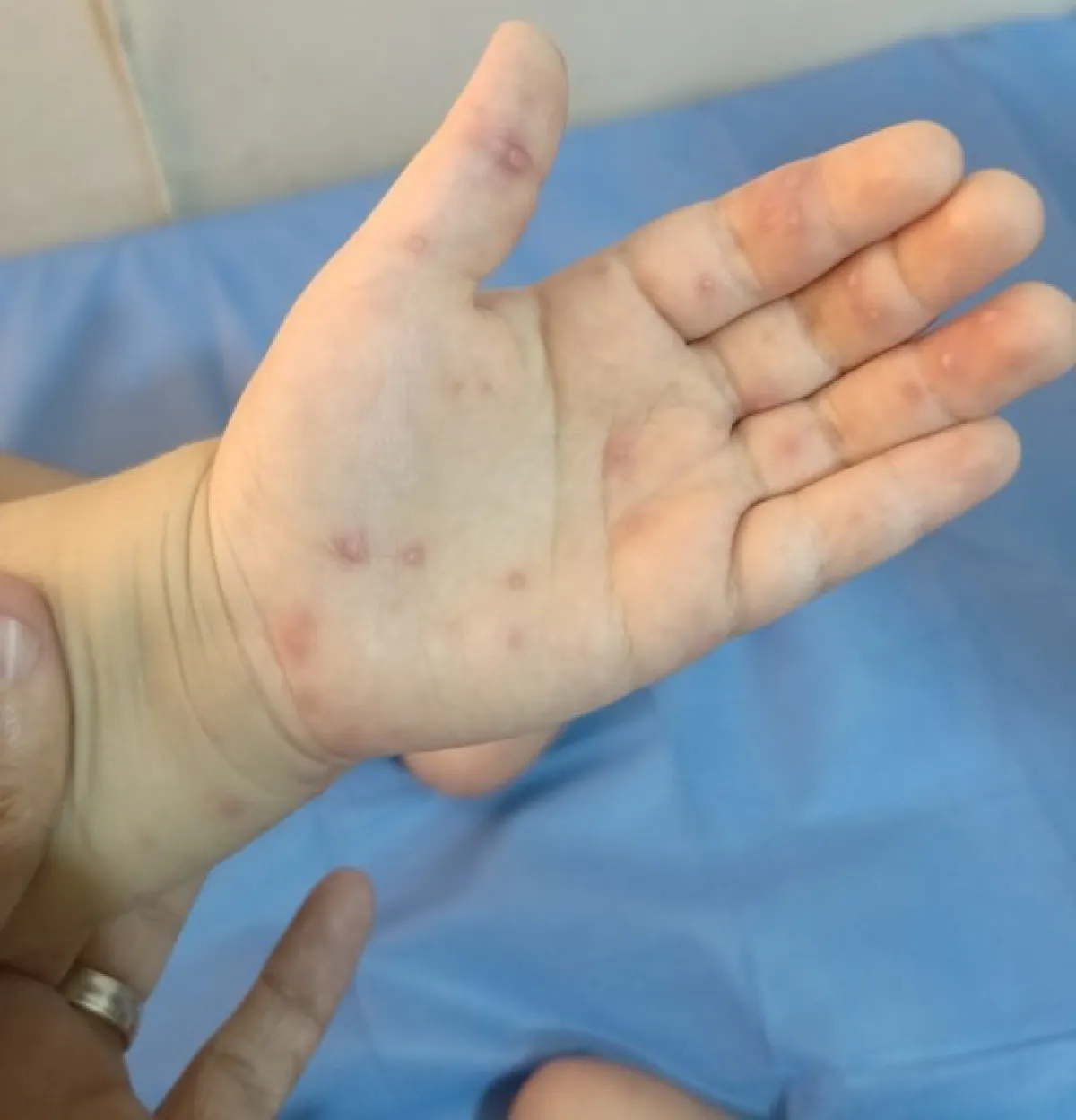 تفشي مرض جلدي معدٍ بين أطفال صنعاء يثير القلق