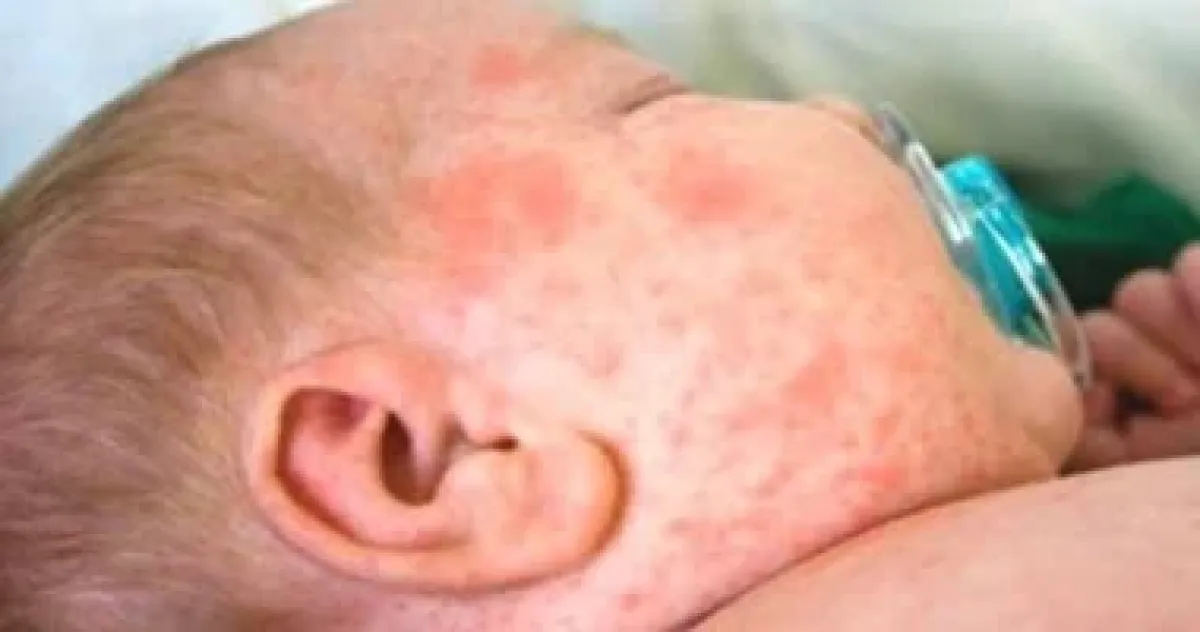 تزايد حالات الحصبة في ساحل حضرموت