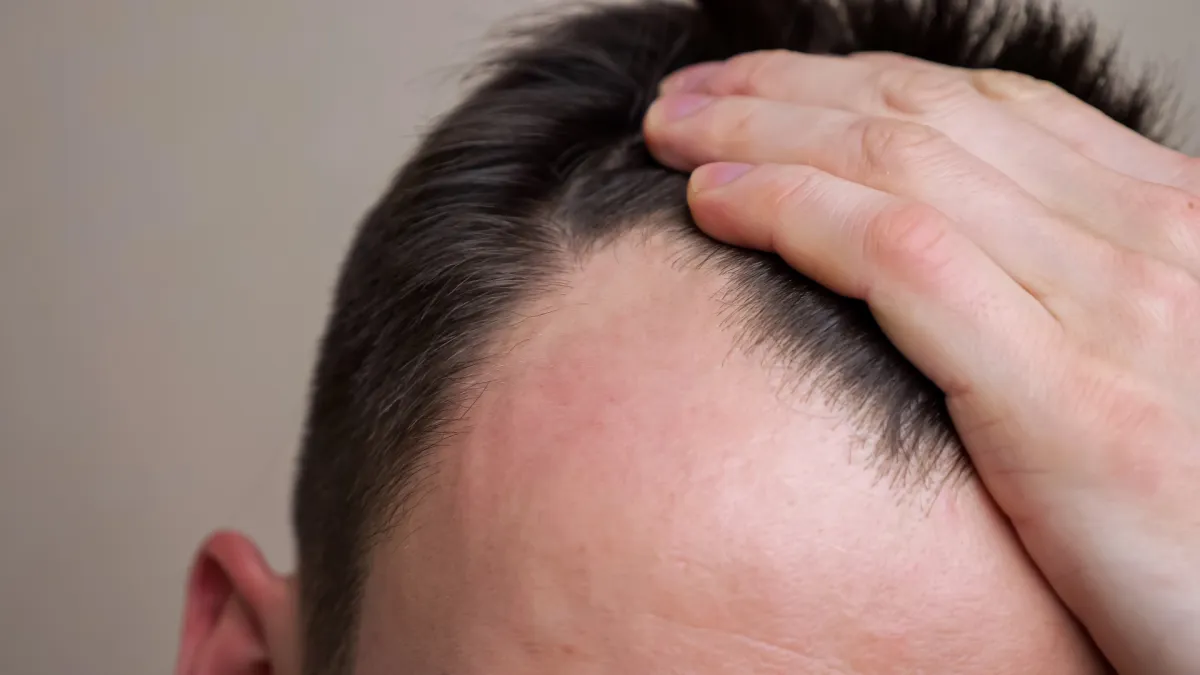 أدوية إنقاص الوزن قد ترتبط بتساقط الشعر لدى الرجال